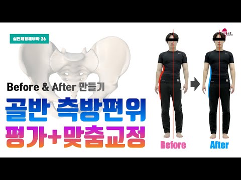 골반 측방편위 3가지 평가. 맞춤형 골반교정 방법. Before & After 만들기 (실전체형해부학 26)