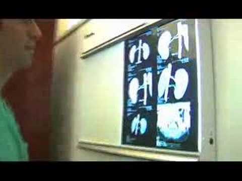Kidney Stones: Causes of Excruciating Pain (Dramat...