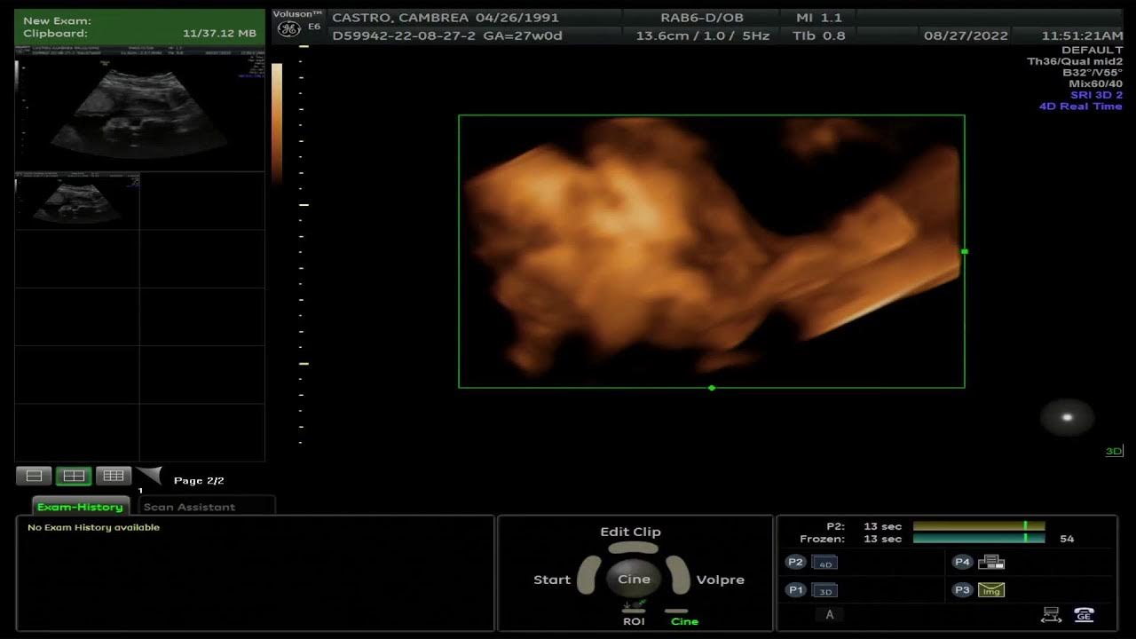 Baby bloom ultrasound live stream youtube