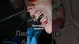 Лигатурные брекеты #зубы #брекеты #braces