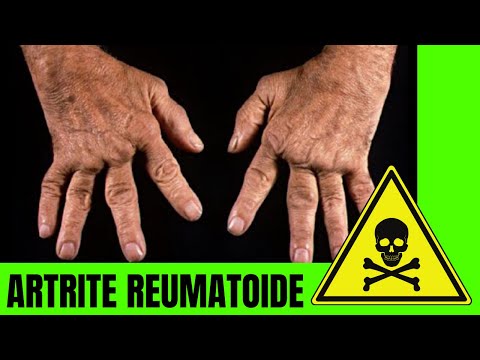Artrite Reumatoide: O