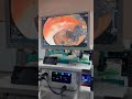 Ercp
