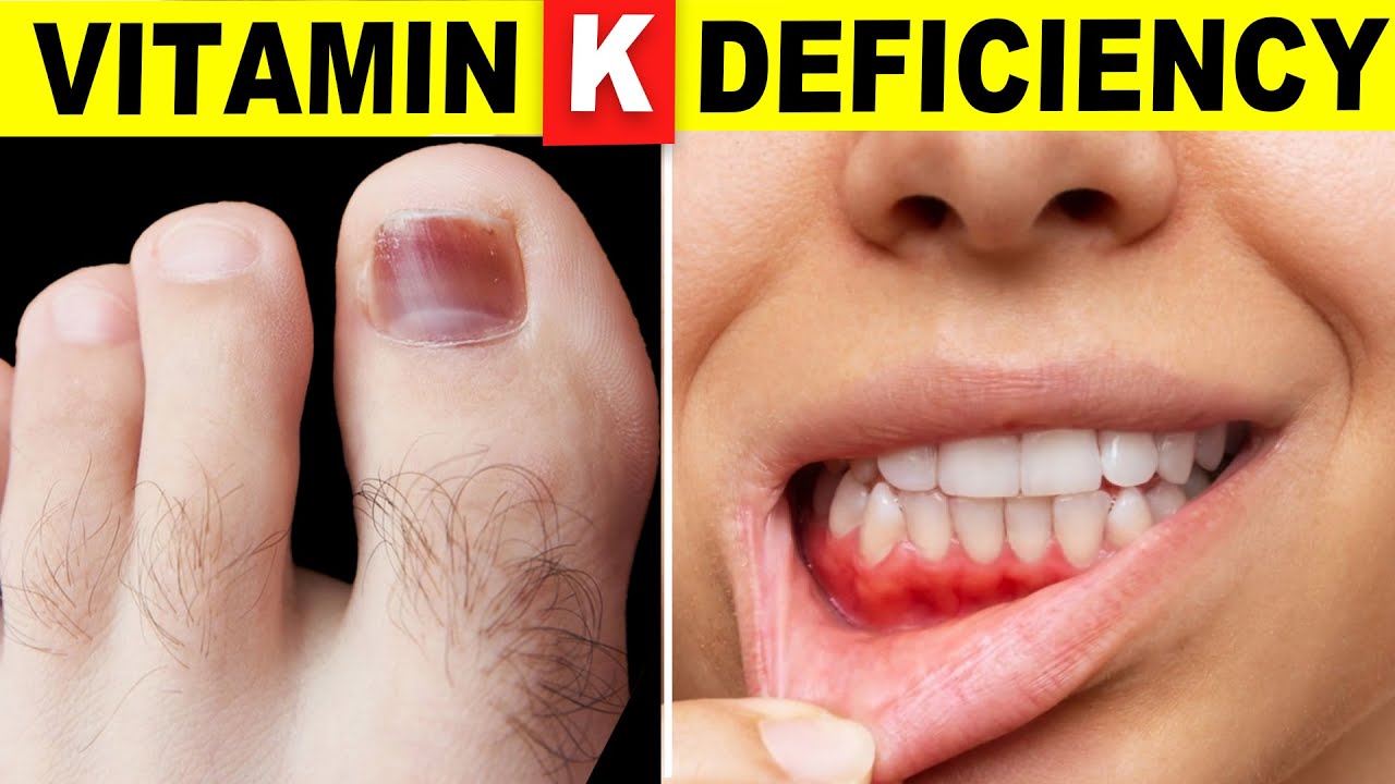 Vitamin K Deficiency vitamin-k-deficiency