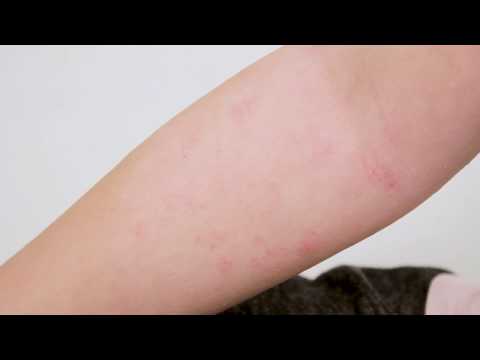 Video: Atopijski dermatitis