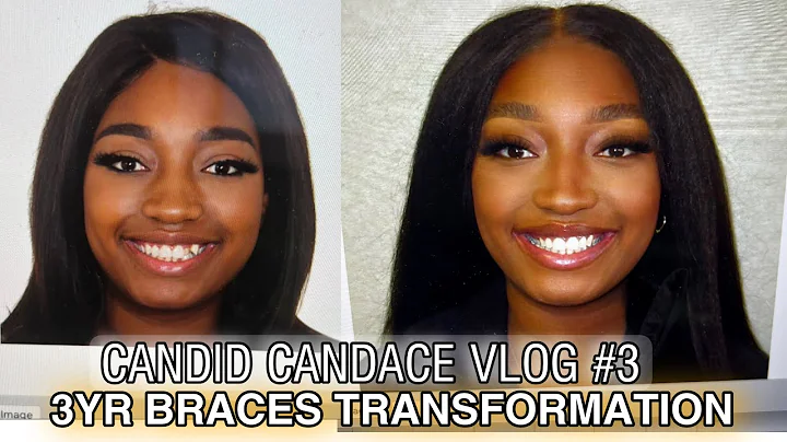 GETTING MY BRACES OFF AFTER 3+ YEARS VLOG | CANDID...