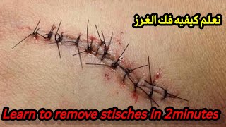 تعلم فك الغرز الجراحيه في ٢دقيقه Learn to remove stitches in 2 minutes