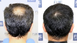 FUE Hair Transplant (1810 FUE Grafts in Crown-Vertex) by Dr. Couto - FUEXPERT CLINIC - Madrid, Spain