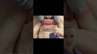 Dissolving migrated lip filler