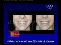 #الستات_مابيعرفوش_يكدبوا ديرما كير كيف تحصلين