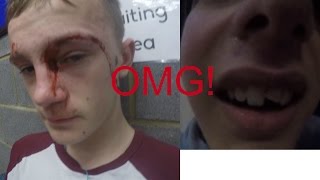 WEBISODE #1 | CORBY | MAD INJURYS!
