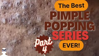 The Best Series PIMPLE POPPING Part 4