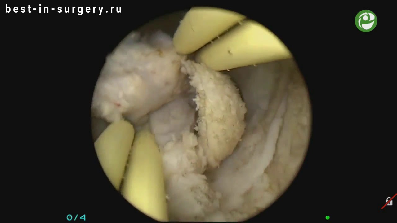Биполярная трансуретральная электрорезекция простаты