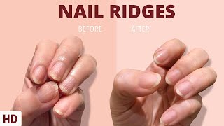 Nail Ridges: The Silent Signaling Your Nails Are Trying to Tell You screenshot 2