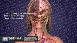 Ischemic Stroke