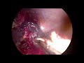 Laparoscopic appendectomy, a difficult case: a perforation at its base with necrosis