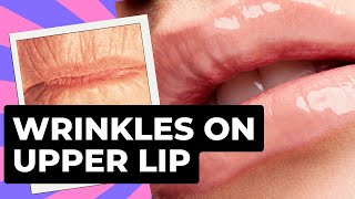 Upper Lip Wrinkles; Gone in 30 days