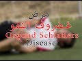 ٤٧) مرض غضروف النمو Osgood Schlatters Disease (ألم الركبة للصبي)