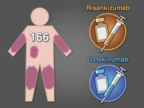 Risankizumab vs. Ustekinumab for Psoriasis