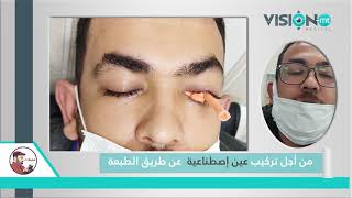 عين إصطناعية عن طريق الطبعة لشاب من ليبيا Artificial eye by impression