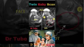 ? Double the Joy - Twin Baby Ultrasound Scans Revealed ?? pregnancy shortsfeed babytwins