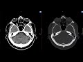 Укладка для КТ ГМ - компьютерной томографии головного мозга