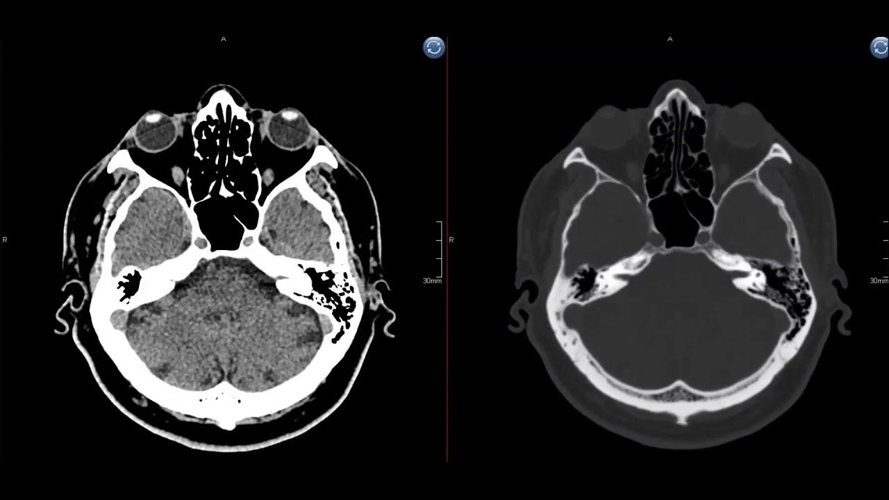 мрт головного мозга атлас. кт мозга минск. опухоль головного мозга на кт. строение головного мозга на кт. мрт мозга.