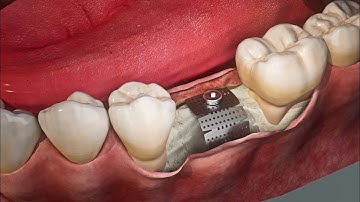 Bone Regeneration using Titanium Membranes