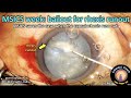 Cataractcoach 1465 msics bailout for capsulorhexis runout