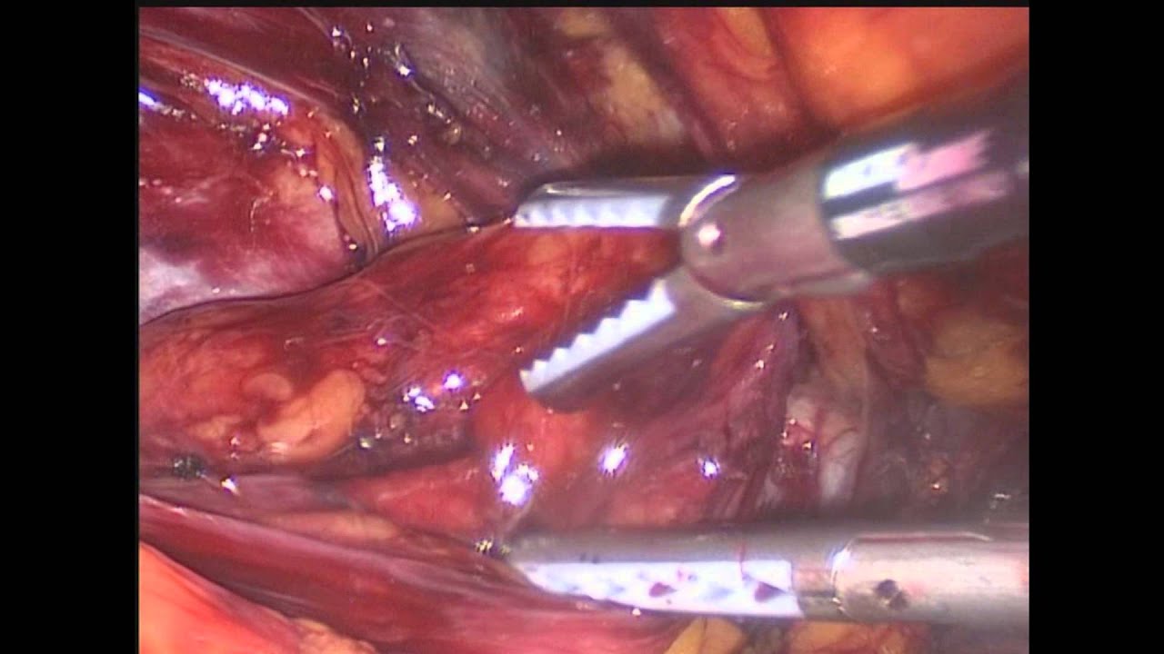 Inguinal Hernia Surgery Wikipedia