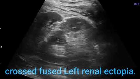 crossed fused Lt renal                                                    ectopia.