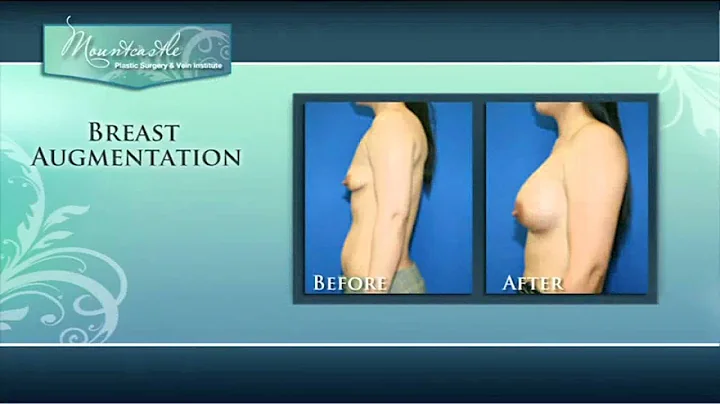 Education on Breast Augmentation with Dr. Mountcas...