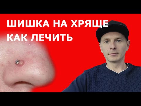 Как лечить шишку на пирсинге хряща уха или носа