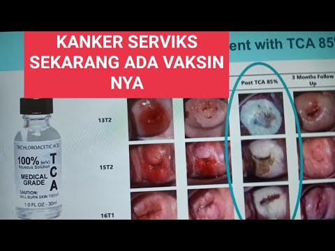 Video: Dapatkah gardasil menyebabkan cacat lahir?