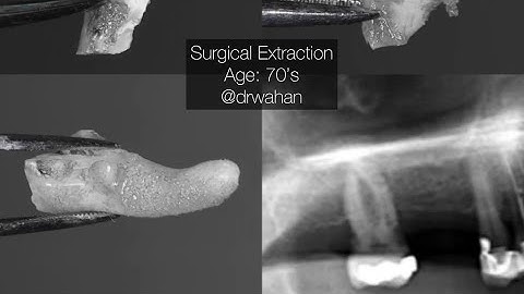 Surgical Maxillary Molar Extraction with Sectioning and Tongue Retraction Tip