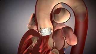 TAVR - Transcatheter Aortic Valve Replacement Animation