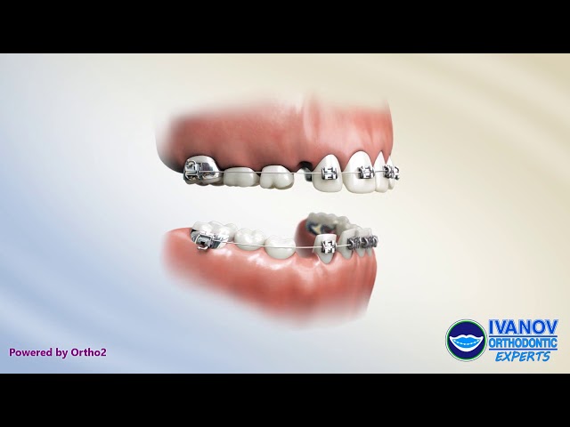 Orthodontic Appliances Explained