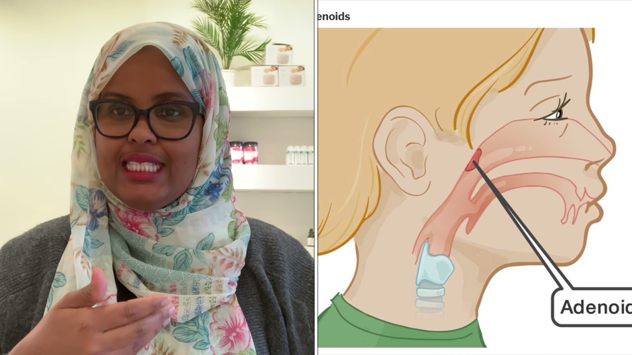 Sanka hilibka ka so Baxa ilmaha iyo calaamadaha Lagu garto iyo sida  loodaweeyo.