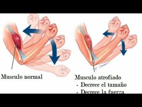 Vídeo: Atrofia Muscular Do Braço, Ombro E Mão - Causas E Sintomas De Atrofia Muscular, Diagnóstico E Tratamento