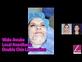 Wide Awake, Local Anesthesia Double Chin Liposuction In-Office