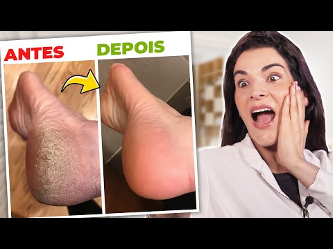 ACABE com PÉS RACHADOS E SECOS em 1 APLICAÇÃO!