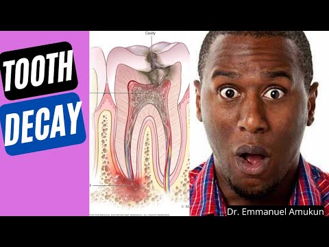 Video: Er tannabscesser vanlig?