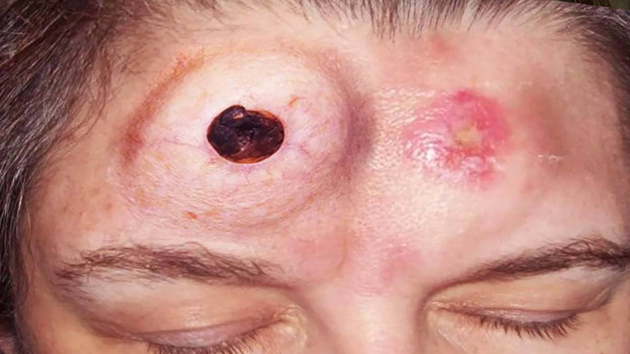 Blackheads vs. Whiteheads Documentary 