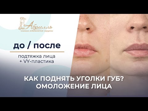 Как поднять уголки губ? Подтяжка лица + увеличение губ  #кочнева #абриелль #спб