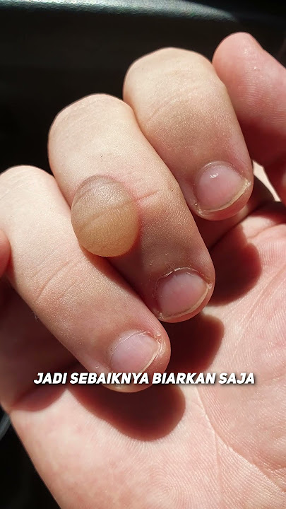 Apakah Kita Seharusnya Pecahin Gelembung 'Kapalan' Atau Lebih Baik Jangan? 🤔🤔