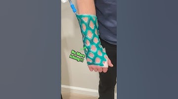 Why This New Cast is a Genius Invention 🤩