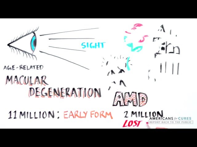 Progress and Promise of Stem Cell Research: Age-Related Macular Degeneration