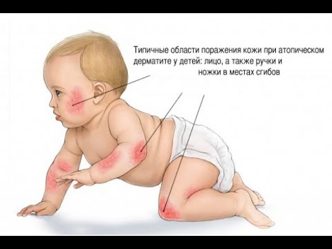 Лекция №15 "Атопический дерматит у детей. Определение,эпидемиология,классификация заболевания"