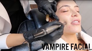 THE VAMPIRE FACIAL: SECRET PROCEDURE | Natalie Eva Marie