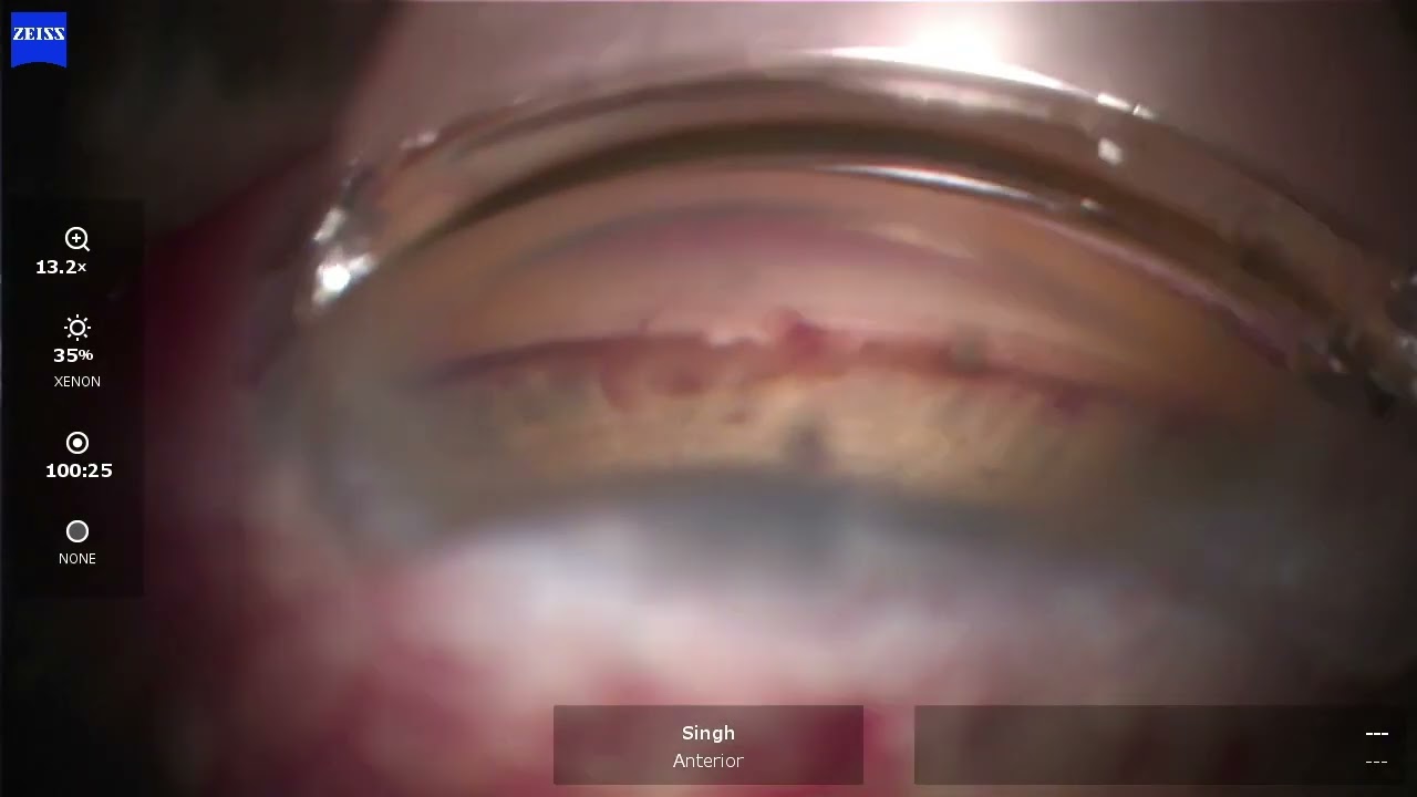 New OMNI ERGO Canaloplasty and Trabeculotomy Device - I Paul Singh, MD
