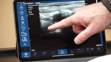 How To Use Your SonoStar Wireless Ultrasound Probe